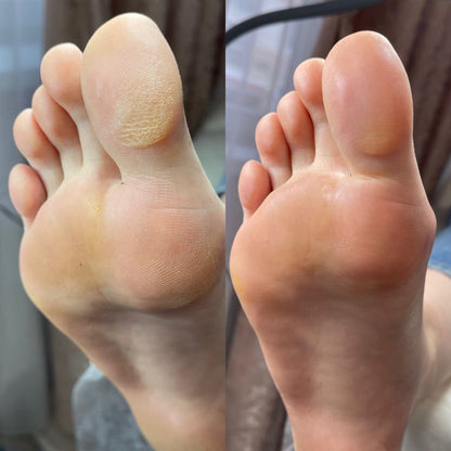 PuraDerma son unos parches para los pies