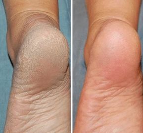 PuraDerma son unos parches para los pies