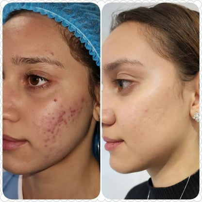 Mascarilla Magnetica Silvetta ELF Limpieza En Segundos