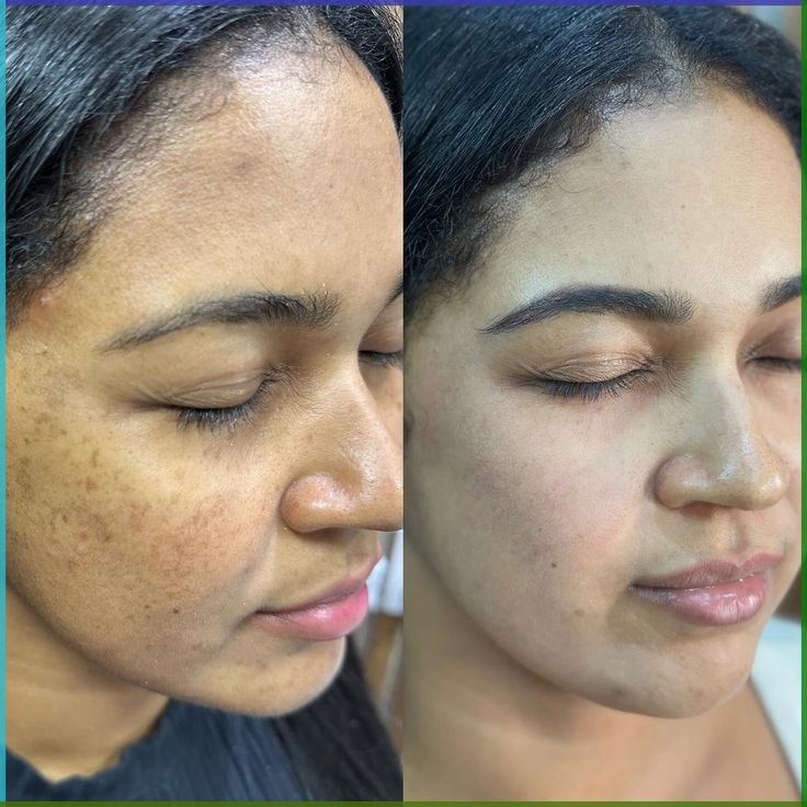Crema para eliminar machas y blanquear la piel Ksecret