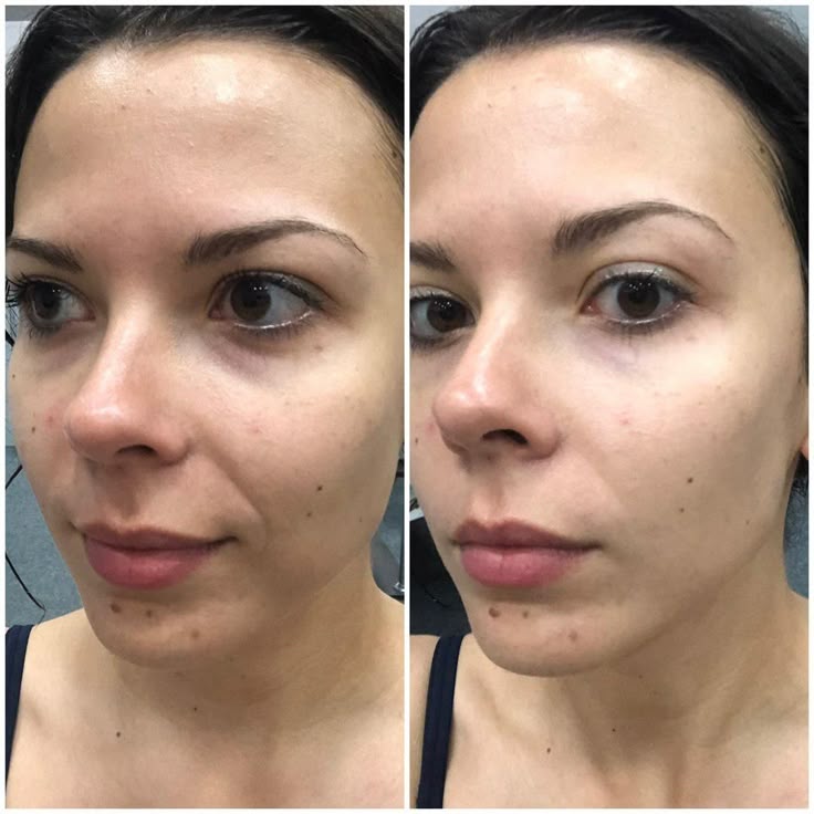 Crema para eliminar machas y blanquear la piel Ksecret
