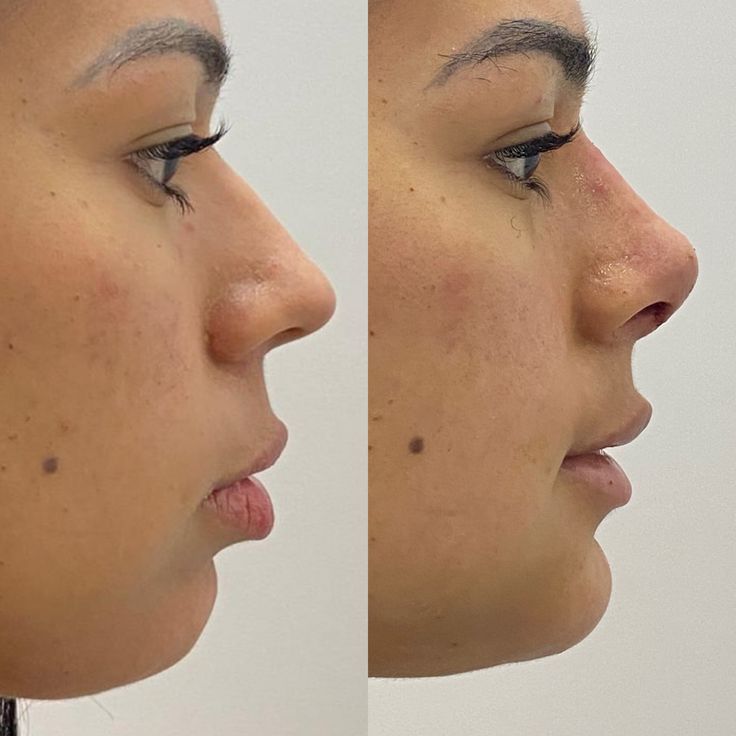 Silvetta ContourFlex Reductor De Papada