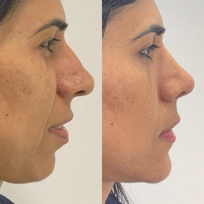 Silvetta ContourFlex Reductor De Papada
