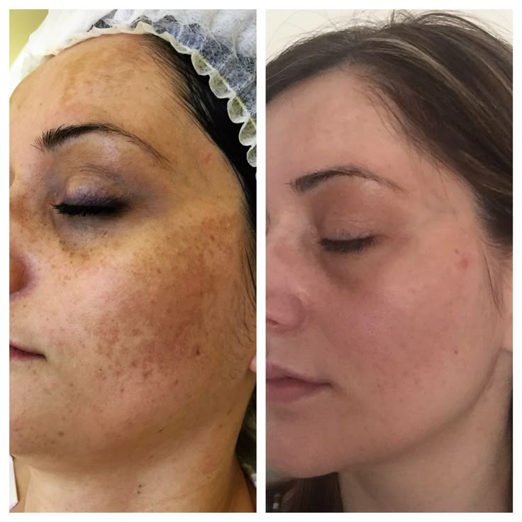 Crema para eliminar machas y blanquear la piel Ksecret