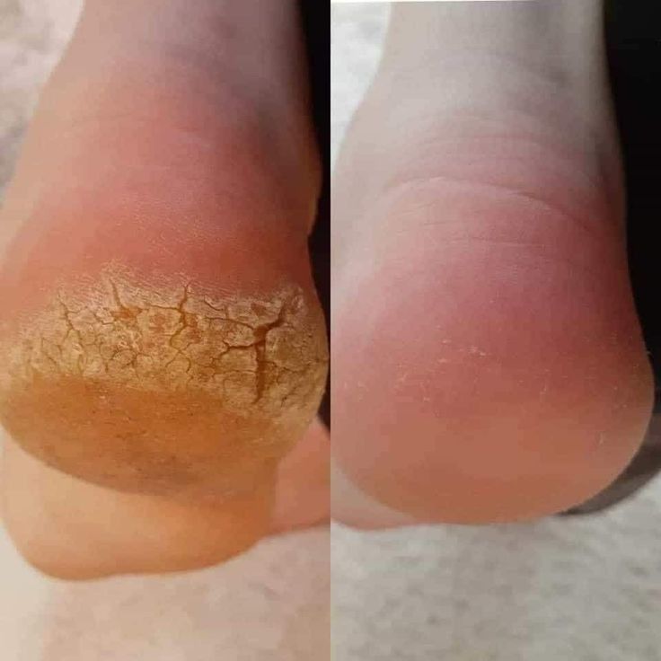 PuraDerma son unos parches para los pies